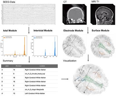 BrainQuake: An Open-Source Python Toolbox for the Stereoelectroencephalography Spatiotemporal Analysis